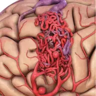 Malformație arterio-venoasă cardiacă: o anomalie complexă a sistemului cardiovascular