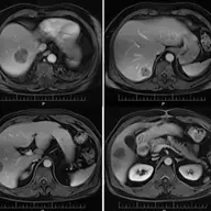 RMN in bolile de ficat si pancreas