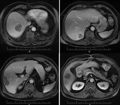 RMN in bolile de ficat si pancreas