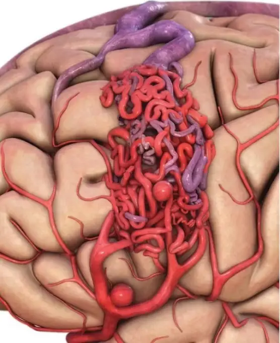 Malformație arterio-venoasă cardiacă: o anomalie complexă a sistemului cardiovascular