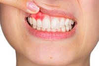 Cum să previi și să tratezi gingivita
